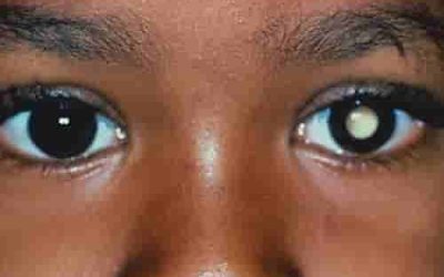 When Should Your Child Have Their First Eye Examination?