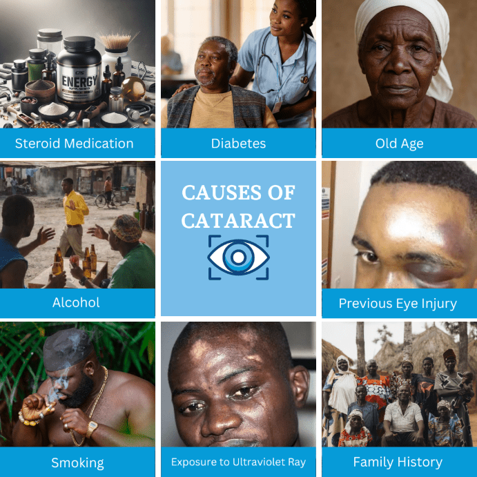 Educational infographic showing the common causes of cataracts, including aging, diabetes, eye injuries, steroid use, smoking, and prolonged UV exposure.